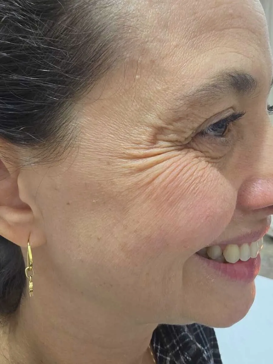 Antes — Botox — Contorno dos Olhos