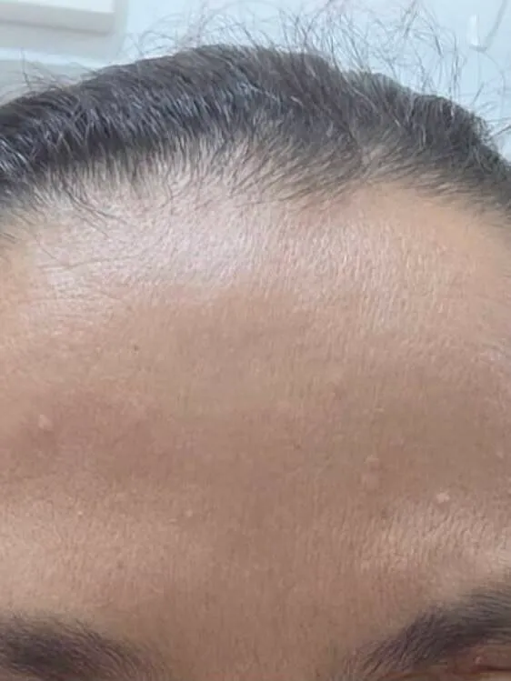 Depois — Botox — Testa