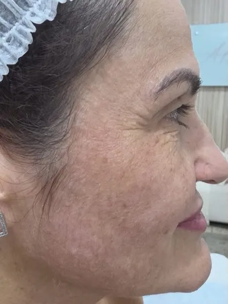 Antes — Perfil Lateral (8 dias)