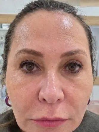 Antes — Rosto Frontal (8 dias)