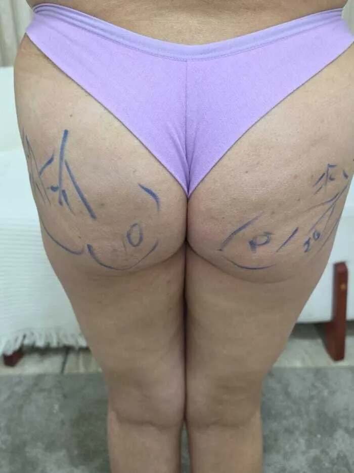 Antes — Estética Corporal