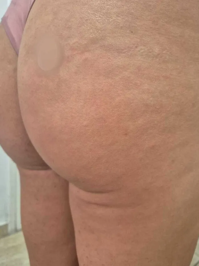 Depois — Estética Corporal