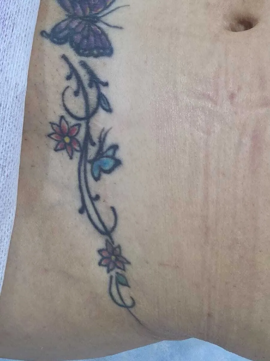 Antes — Remoção de Tatuagem